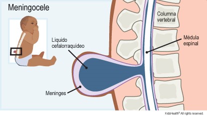 Meningocele / hernia de las meninges – Infogen